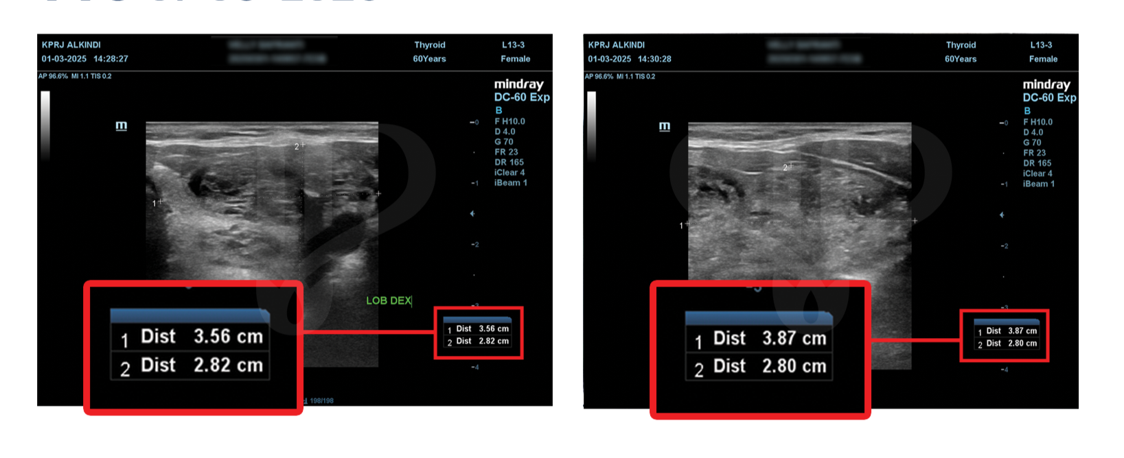 Hasil USG awal pasien Graves Disease pada 01 Maret 2025